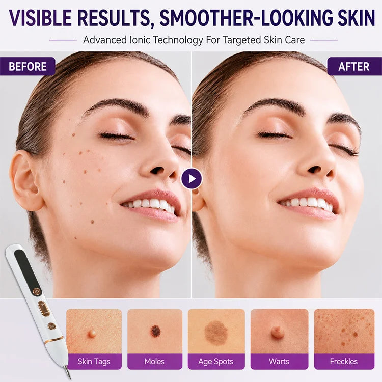 Precision Mole & Skin Tag Removal Pen